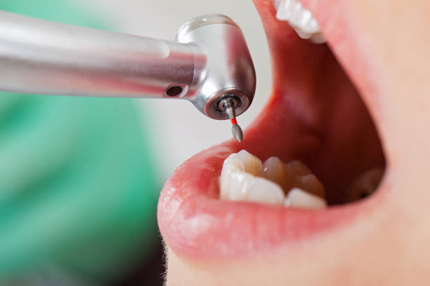 Best Emergency Wisdom Teeth Removal in Waterloo, WI